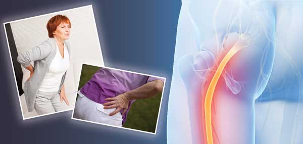 Sciatica